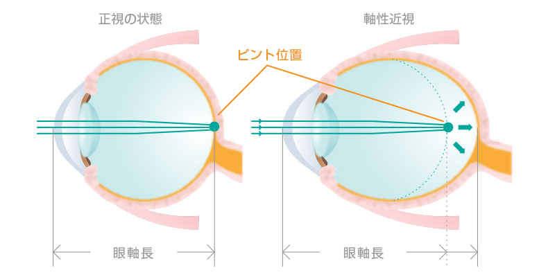 近視抑制（低濃度アトロピン点眼） | 宮本眼科クリニック